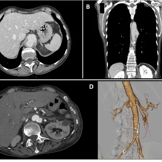 CT Aortic Angiography